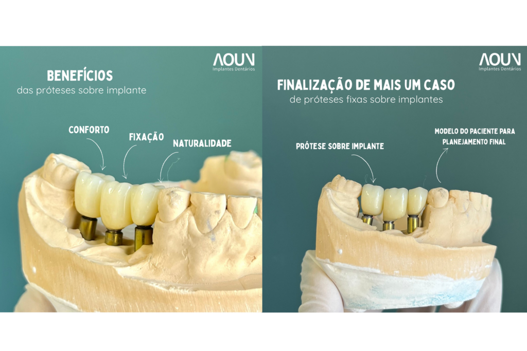 benefícios da prótese sobre implante