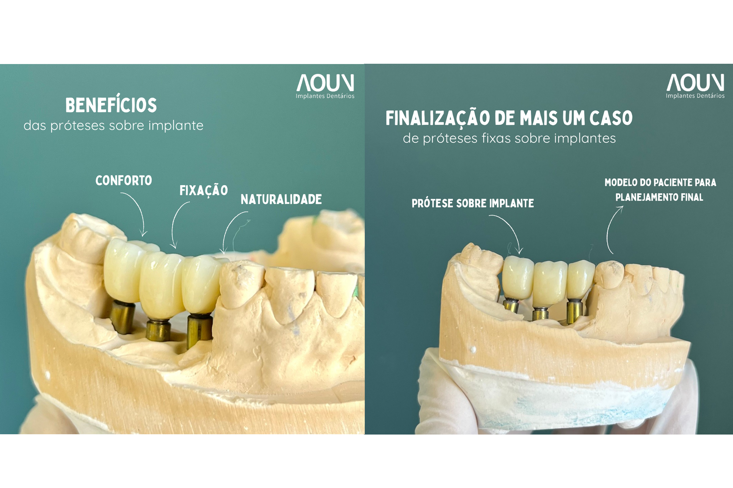 benefícios da prótese sobre implante