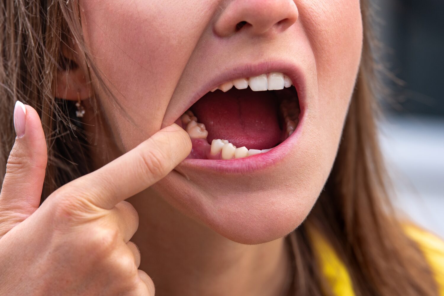 Dente Quebrado Ou Trincado