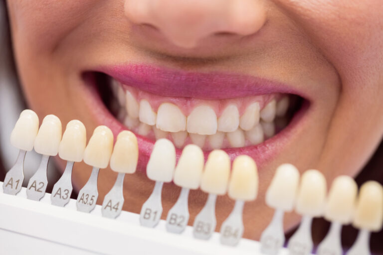 Quem tem bruxismo pode usar lentes de contato dental?