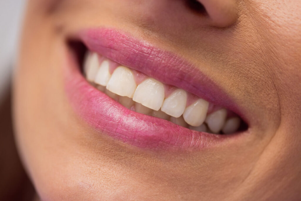 Close do sorriso com restauração de resina imperceptível e dentes alinhados, realizados na Aoun Clínica Odontológica em Guarulhos.