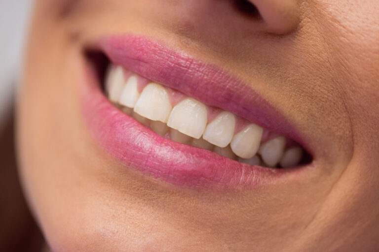 Close do sorriso com restauração de resina imperceptível e dentes alinhados, realizados na Aoun Clínica Odontológica em Guarulhos.