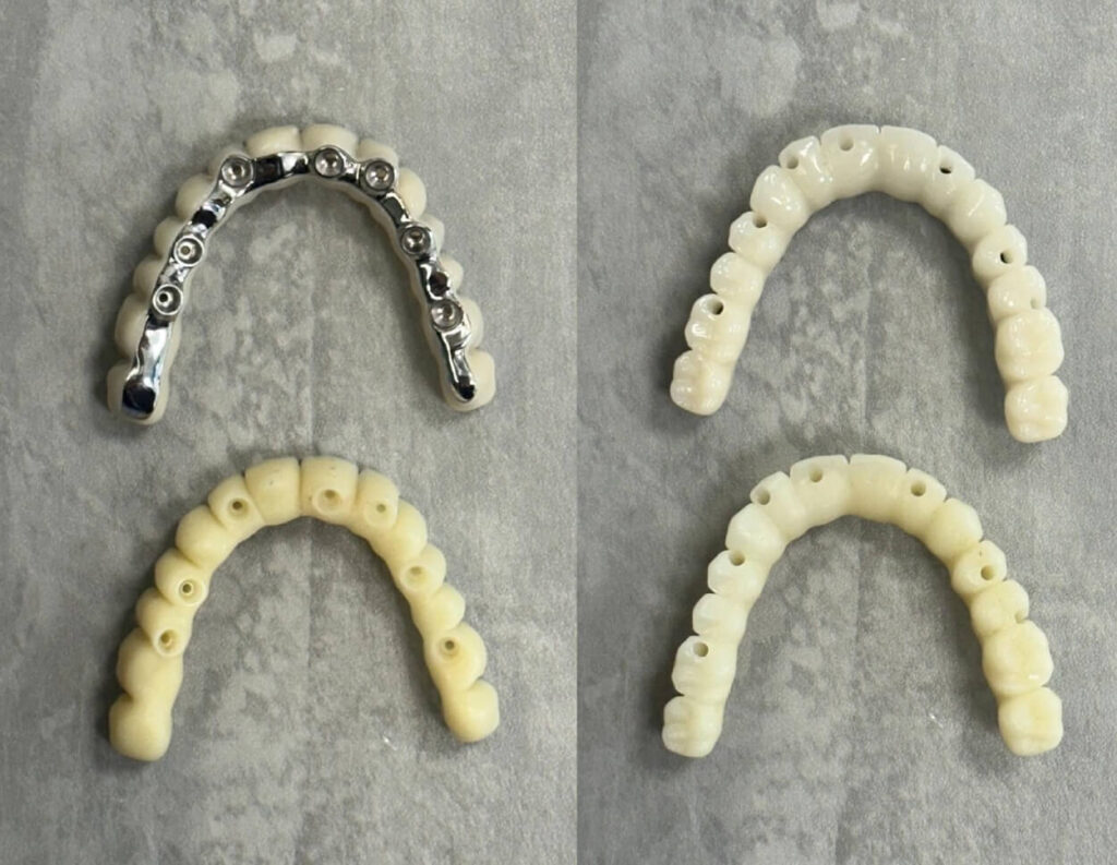 Imagem comparativa mostrando uma Prótese Protocolo superior definitiva em zircônia com conexões metálicas, posicionada acima do seu modelo de prova (Try-in) em resina, confeccionada pela Aoun Implantes em Guarulhos